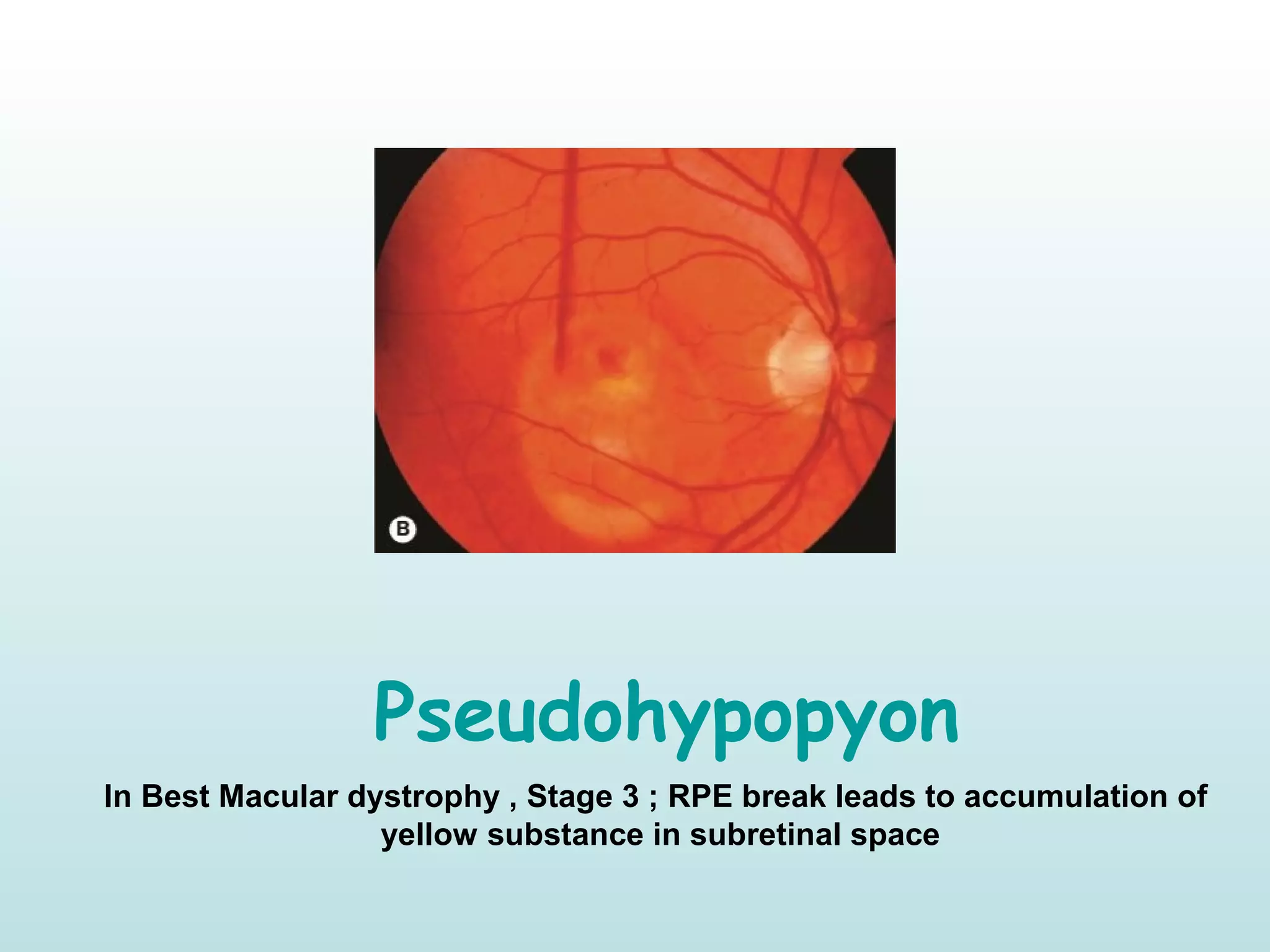 Pseudohypopyon
In Best Macular dystrophy , Stage 3 ; RPE break leads to accumulation of
yellow substance in subretinal space
 
