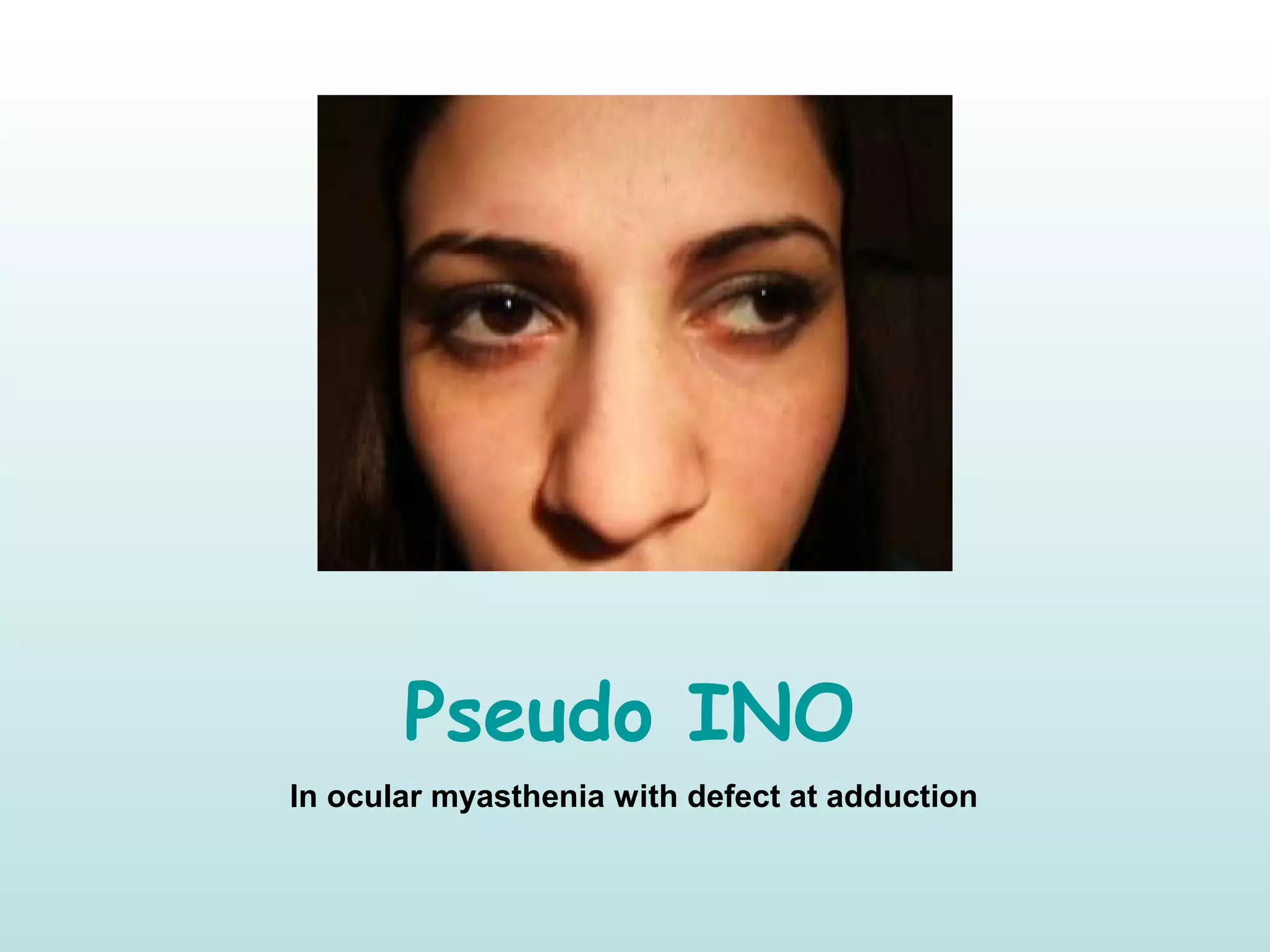 Pseudo INO
In ocular myasthenia with defect at adduction
 