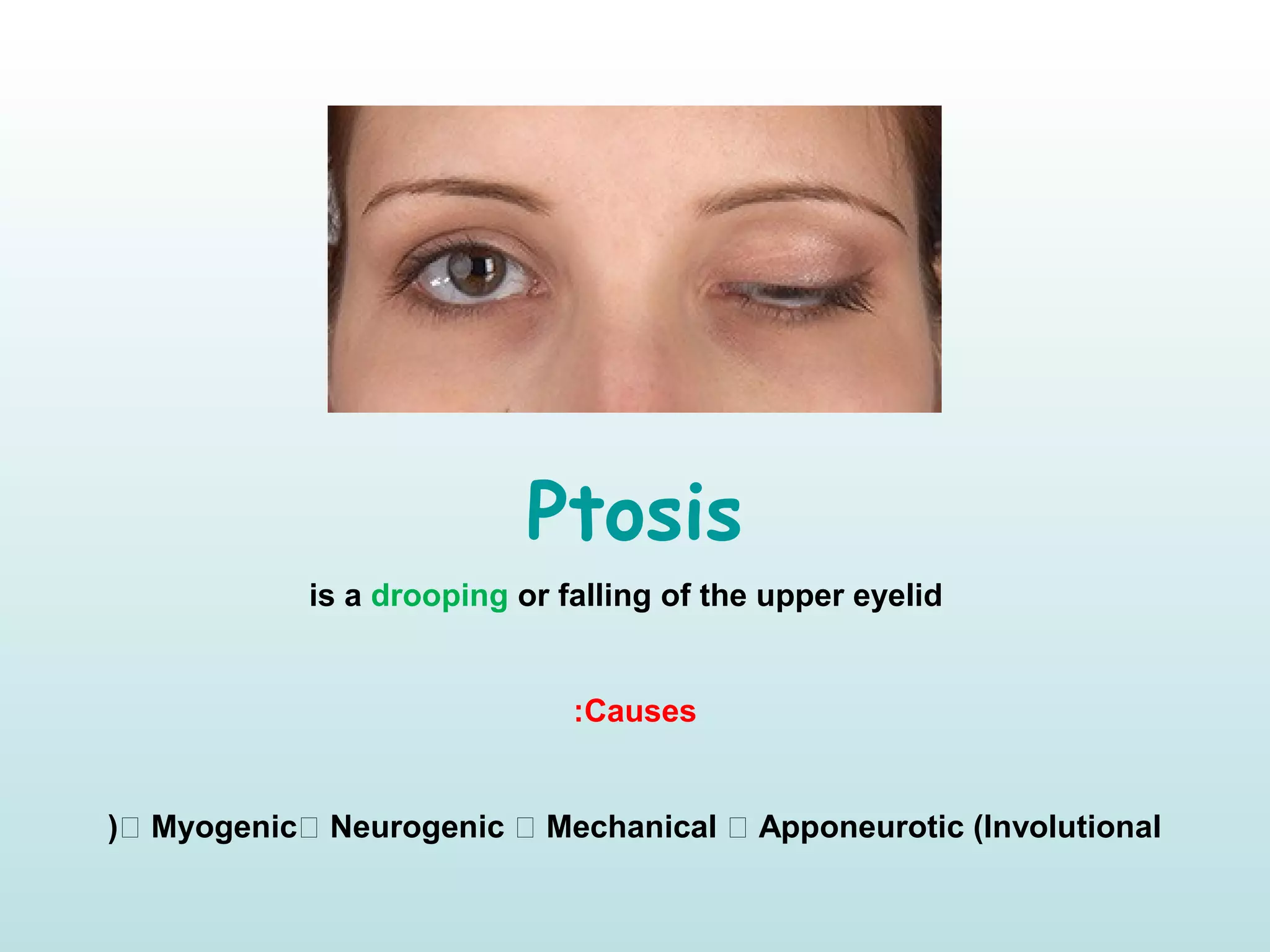 Ptosis
is a drooping or falling of the upper eyelid
Causes:
 Myogenic Neurogenic  Mechanical  Apponeurotic (Involutional(
 