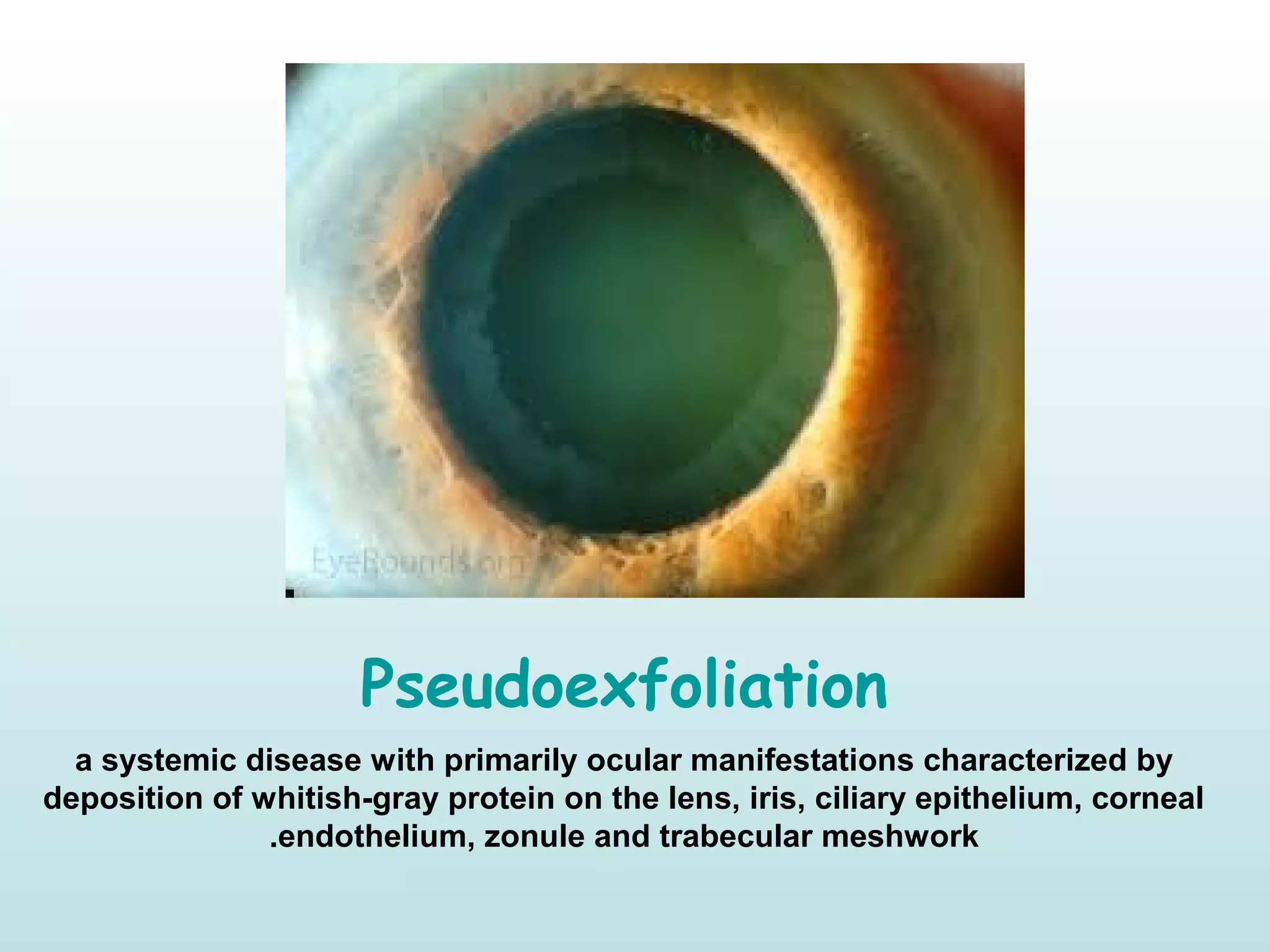 Pseudoexfoliation
a systemic disease with primarily ocular manifestations characterized by
deposition of whitish-gray protein on the lens, iris, ciliary epithelium, corneal
endothelium, zonule and trabecular meshwork.
 