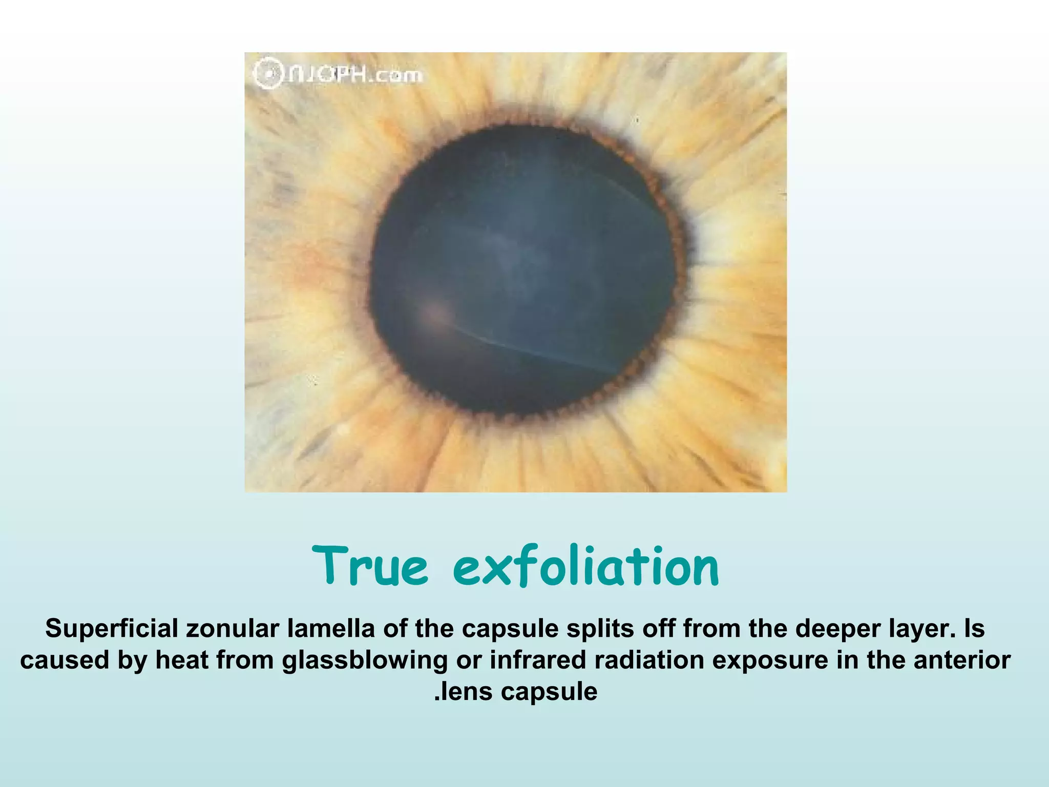 True exfoliation
Superficial zonular lamella of the capsule splits off from the deeper layer. Is
caused by heat from glassblowing or infrared radiation exposure in the anterior
lens capsule.
 