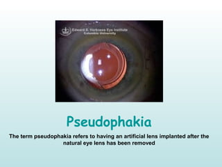 Pseudophakia
The term pseudophakia refers to having an artificial lens implanted after the
natural eye lens has been removed
 