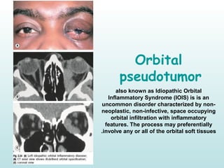 Orbital
pseudotumor
also known as Idiopathic Orbital
Inflammatory Syndrome )IOIS( is is an
uncommon disorder characterized by non-
neoplastic, non-infective, space occupying
orbital infiltration with inflammatory
features. The process may preferentially
involve any or all of the orbital soft tissues.
 