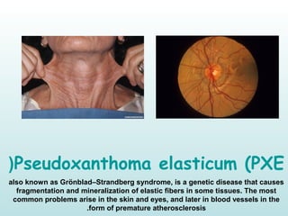 Pseudoxanthoma elasticum (PXE(
also known as Grönblad–Strandberg syndrome, is a genetic disease that causes
fragmentation and mineralization of elastic fibers in some tissues. The most
common problems arise in the skin and eyes, and later in blood vessels in the
form of premature atherosclerosis.
 