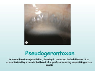 Pseudogerontoxon
In vernal keartoconjunctivitis , develop in recurrent limbal disease. It is
characterized by a paralimbal band of superficial scarring resembling arcus
senilis
 