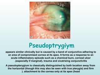 Pseudoptrygiym
appears similar clinically but is caused by a band of conjunctiva adhering to
an area of compromised cornea at its apex. It forms as a response to an
acute inflammatory episode such as a chemical burn, corneal ulcer
)especially if marginal(, trauma and cicatrizing conjunctivitis.
A pseudopterygium is classically distinguished by both location away from
the horizontal )though this may also be seen with true pterygia( and firm
attachment to the cornea only at its apex )head(.
 