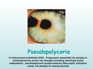 Pseudopolycoria
In Iridocorneal endothelial )ICE( , Progressive )essential( iris atrophy is
characterized by severe iris changes including corectopia )pupil
malposition( , pseudopolycoria )supernumerary false pupil(, ectropion
uveae, iris atrophy of varying severity
 