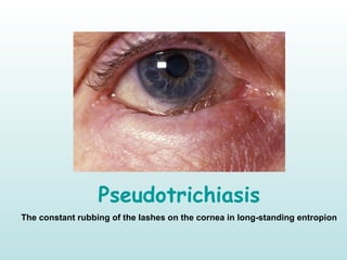 Pseudotrichiasis
The constant rubbing of the lashes on the cornea in long-standing entropion
 