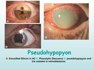 Pseudohypopyon
B- Emusified Silicon in AC C- Phacolytic Glaucoma D- psuedohypopyon and
iris nodules in retinoblastoma
 
