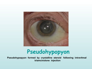 Pseudohypopyon
Pseudohypopyon formed by crystalline steroid following intravitreal             
triamcinolone injection 
 