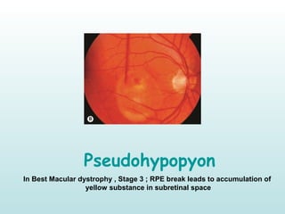 Pseudohypopyon
In Best Macular dystrophy , Stage 3 ; RPE break leads to accumulation of
yellow substance in subretinal space
 