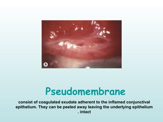 Pseudomembrane
consist of coagulated exudate adherent to the inflamed conjunctival
epithelium. They can be peeled away leaving the underlying epithelium
intact.
 