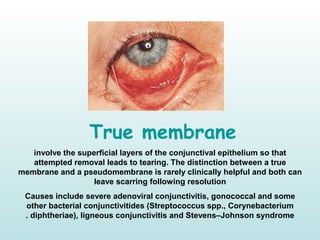 True membrane
involve the superficial layers of the conjunctival epithelium so that
attempted removal leads to tearing. The distinction between a true
membrane and a pseudomembrane is rarely clinically helpful and both can
leave scarring following resolution
Causes include severe adenoviral conjunctivitis, gonococcal and some
other bacterial conjunctivitides (Streptococcus spp., Corynebacterium
diphtheriae), ligneous conjunctivitis and Stevens–Johnson syndrome.
 