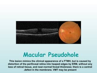 Macular Pseudohole
This lesion mimics the clinical appearance of a FTMH, but is caused by
distortion of the perifoveal retina into heaped edges by ERM, without any
loss of retinal tissue, and near-normal foveal thickness; there is a central
defect in the membrane. VMT may be present.
 