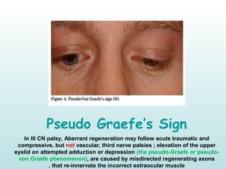 Pseudo Graefe’s Sign
In III CN palsy, Aberrant regeneration may follow acute traumatic and
compressive, but not vascular, third nerve palsies ; elevation of the upper
eyelid on attempted adduction or depression (the pseudo-Graefe or pseudo-
von Graefe phenomenon), are caused by misdirected regenerating axons
that re-innervate the incorrect extraocular muscle.
 