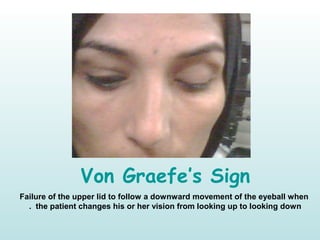 Von Graefe’s Sign
Failure of the upper lid to follow a downward movement of the eyeball when
the patient changes his or her vision from looking up to looking down.
 