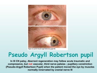 Pseudo Argyll Robertson pupil
In III CN palsy, Aberrant regeneration may follow acute traumatic and
compressive, but not vascular, third nerve palsies ; pupillary constriction
(Pseudo-Argyll Robertson Pupil) when the patient moved the eye by muscles
normally innervated by cranial nerve III
 
