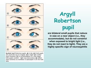 Argyll
Robertson
pupil
are bilateral small pupils that reduce
in size on a near object (i.e., they
accommodate), but do not constrict
when exposed to bright light (i.e.,
they do not react to light). They are a
highly specific sign of neurosyphilis
 