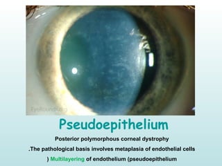 Pseudoepithelium
Posterior polymorphous corneal dystrophy
The pathological basis involves metaplasia of endothelial cells.
Multilayering of endothelium (pseudoepithelium)
 
