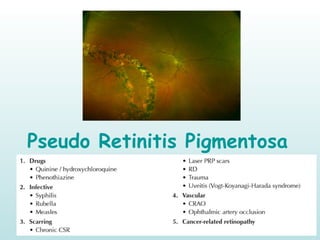 Pseudo Retinitis Pigmentosa
 