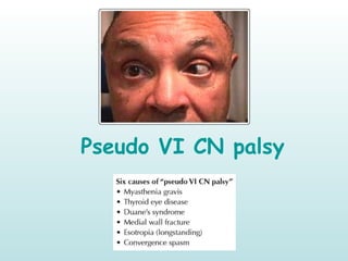 Pseudo VI CN palsy
 