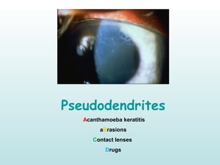 Pseudodendrites
Acanthamoeba keratitis
aBrasions
Contact lenses
Drugs
 