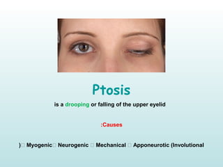 Ptosis
is a drooping or falling of the upper eyelid
Causes:
 Myogenic Neurogenic  Mechanical  Apponeurotic (Involutional(
 