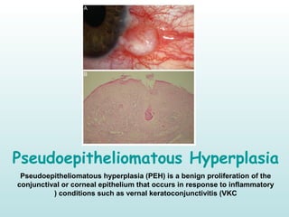 Pseudoepitheliomatous Hyperplasia
Pseudoepitheliomatous hyperplasia (PEH) is a benign proliferation of the
conjunctival or corneal epithelium that occurs in response to inflammatory
conditions such as vernal keratoconjunctivitis (VKC)
 