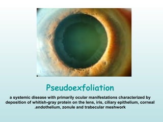 Pseudoexfoliation
a systemic disease with primarily ocular manifestations characterized by
deposition of whitish-gray protein on the lens, iris, ciliary epithelium, corneal
endothelium, zonule and trabecular meshwork.
 