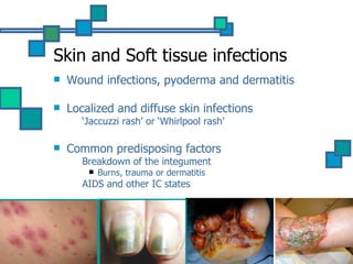 Diffuse Vs Localized Rash Pseudo+acineto | PPT