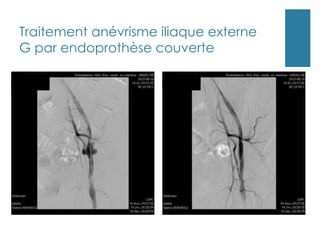 Traitement anévrisme iliaque externe
G par endoprothèse couverte
 