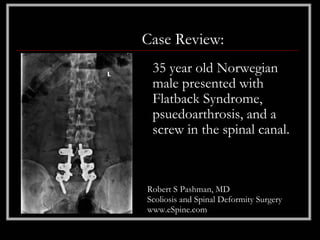 Case Review:
 35 year old Norwegian
 male presented with
 Flatback Syndrome,
 psuedoarthrosis, and a
 screw in the spinal canal.



Robert S Pashman, MD
Scoliosis and Spinal Deformity Surgery
www.eSpine.com
 