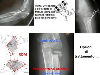 ♂10	
  a.	
  Osteosintesi	
  	
  
a	
  cielo	
  aperto	
  di	
  
fraQura	
  scomposta	
  
capitello	
  radiale	
  sx	
  
(lato	
  non	
  dominante)	
  

Controllo	
  1	
  a.	
  	
  
Opzioni	
  	
  
di	
  
traQamento....	
  

ROM	
  

Pseudoartrosi	
  atroﬁca	
  
(lieve	
  dolore)	
  

 