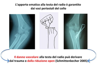 L’apporto	
  emaaco	
  alla	
  testa	
  del	
  radio	
  è	
  garanato	
  	
  
dai	
  vasi	
  periostali	
  del	
  collo	
  

Il	
  danno	
  vascolare	
  alla	
  testa	
  del	
  radio	
  può	
  derivare	
  	
  
dal	
  trauma	
  o	
  dalla	
  riduzione	
  open	
  (SchmiQenbecher	
  2005)	
  

 