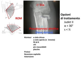 ♂	
  11a	
  	
  
Opzioni	
  	
  
di	
  traQamento	
  
ROM	
  
	
  	
  	
  	
  	
  Judet	
  II	
  
	
  	
  	
  	
  	
  α	
  <	
  30°	
  
Pseudoartrosi	
  atroﬁca	
   	
  	
  	
  	
  	
  s	
  <	
  ½	
  	
  
(lieve	
  dolore)	
  
	
  
	
  
Risintesi	
  	
  	
  	
  a	
  cielo	
  chiuso	
  	
  
	
  
	
  	
  	
  a	
  cielo	
  aperto	
  (±	
 innesto)	
  
	
  
	
  	
  	
  ﬁli	
  di	
  K	
  
	
  
	
  	
  	
  via	
  
	
  
	
  	
  	
  pin	
  riassorbibili	
  
	
  
	
  	
  	
  placche	
  
Protesi	
  
Resezione	
  capitello	
  
Astensione	
  
	
  

 