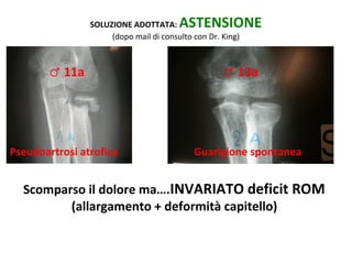 ASTENSIONE	
  

SOLUZIONE	
  ADOTTATA:	
  
(dopo	
  mail	
  di	
  consulto	
  con	
  Dr.	
  King)	
  

♂	
  11a	
  	
  

Pseudoartrosi	
  atroﬁca	
  

♂	
  13a	
  	
  

Guarigione	
  spontanea	
  

Scomparso	
  il	
  dolore	
  ma….INVARIATO	
  deﬁcit	
  ROM	
  	
  
(allargamento	
  +	
  deformità	
  capitello)	
  	
  

 