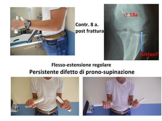 ♂	
  18a	
  	
  
Contr.	
  8	
  a.	
  	
  
post	
  fraQura	
  

Artrosi?	
  
Flesso-­‐estensione	
  regolare	
  

	
  Persistente	
  difeQo	
  di	
  prono-­‐supinazione	
  

 