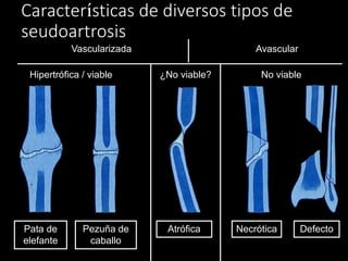 Características de diversos tipos de
seudoartrosis
Vascularizada
Pata de
elefante
Pezuña de
caballo
Atrófica Necrótica Defecto
Avascular
Hipertrófica / viable ¿No viable? No viable
 