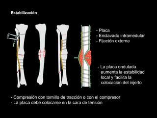 Estabilización
- Placa
- Enclavado intramedular
- Fijación externa
- Compresión con tornillo de tracción o con el compresor
- La placa debe colocarse en la cara de tensión
- La placa ondulada
aumenta la estabilidad
local y facilita la
colocación del injerto
 