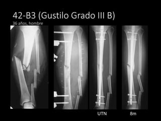 42-B3 (Gustilo Grado III B)
36 años, hombre
8mUTN
 
