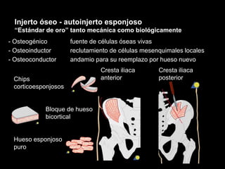 Chips
corticoesponjosos
Bloque de hueso
bicortical
Hueso esponjoso
puro
Cresta iliaca
anterior
Cresta iliaca
posterior
Injerto óseo - autoinjerto esponjoso
“Estándar de oro” tanto mecánica como biológicamente
- Osteogénico fuente de células óseas vivas
- Osteoinductor reclutamiento de células mesenquimales locales
- Osteoconductor andamio para su reemplazo por hueso nuevo
 
