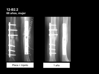 12-B2.2
68 años, mujer
Placa + Injerto 1 año
 