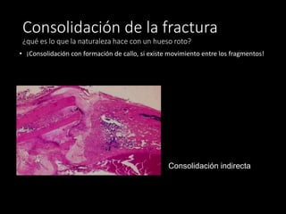 Consolidación de la fractura
¿qué es lo que la naturaleza hace con un hueso roto?
• ¡Consolidación con formación de callo, si existe movimiento entre los fragmentos!
Consolidación indirecta
 