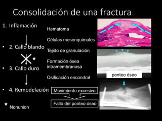Consolidación de una fractura
1. Inflamación
• 2. Callo blando
• 3. Callo duro
• 4. Remodelación
ponteo óseo
Fallo del ponteo óseo
Movimiento excesivo
Hematoma
Células mesenquimales
Tejido de granulación
Formación ósea
intramembranosa
Osificación encondral
*
* Nonunion
 