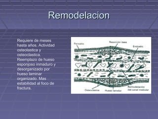 RReemmooddeellaacciioonn 
Requiere de meses 
hasta años. Actividad 
osteolastica y 
osteoclastica. 
Reemplazo de hueso 
esponjoso inmaduro y 
desorganizado por 
hueso laminar 
organizado. Mas 
estabilidad al foco de 
fractura. 
 