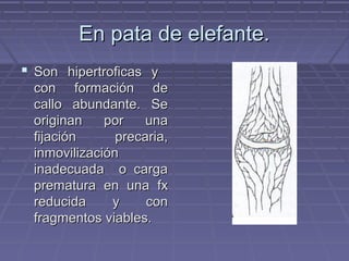 EEnn ppaattaa ddee eelleeffaannttee.. 
 SSoonn hhiippeerrttrrooffiiccaass yy 
ccoonn ffoorrmmaacciióónn ddee 
ccaalllloo aabbuunnddaannttee.. SSee 
oorriiggiinnaann ppoorr uunnaa 
ffiijjaacciióónn pprreeccaarriiaa,, 
iinnmmoovviilliizzaacciióónn 
iinnaaddeeccuuaaddaa oo ccaarrggaa 
pprreemmaattuurraa eenn uunnaa ffxx 
rreedduucciiddaa yy ccoonn 
ffrraaggmmeennttooss vviiaabblleess.. 
 