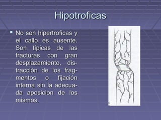 HHiippoottrrooffiiccaass 
 NNoo ssoonn hhiippeerrttrrooffiiccaass yy 
eell ccaalllloo eess aauusseennttee.. 
SSoonn ttííppiiccaass ddee llaass 
ffrraaccttuurraass ccoonn ggrraann 
ddeessppllaazzaammiieennttoo,, ddiiss-- 
ttrraacccciióónn ddee llooss ffrraagg-- 
mmeennttooss oo ffiijjaacciióónn 
iinntteerrnnaa ssiinn llaa aaddeeccuuaa-- 
ddaa aappoossiicciioonn ddee llooss 
mmiissmmooss.. 
 