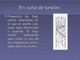 EEnn ccuuññaa ddee ttoorrssiióónn.. 
 PPrreesseenncciiaa ddee ffrraagg-- 
mmeennttoo iinntteerrmmeeddiioo eenn 
eell qquuee eell aappoorrttee vvaass-- 
ccuullaarr eessttaa ddiissmmiinnuuiiddoo 
oo aauusseennttee.. EEll ffrraagg-- 
mmeennttoo iinntteerrmmeeddiioo 
eessttaa uunniiddoo aa uunnoo ddee 
llooss ffrraaggmmeennttooss pprriinnccii-- 
ppaalleess ppeerroo nnoo aall oottrroo.. 
 