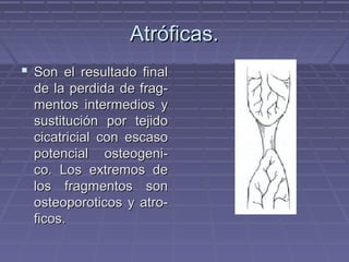 AAttrróóffiiccaass.. 
 SSoonn eell rreessuullttaaddoo ffiinnaall 
ddee llaa ppeerrddiiddaa ddee ffrraagg-- 
mmeennttooss iinntteerrmmeeddiiooss yy 
ssuussttiittuucciióónn ppoorr tteejjiiddoo 
cciiccaattrriicciiaall ccoonn eessccaassoo 
ppootteenncciiaall oosstteeooggeennii-- 
ccoo.. LLooss eexxttrreemmooss ddee 
llooss ffrraaggmmeennttooss ssoonn 
oosstteeooppoorroottiiccooss yy aattrroo-- 
ffiiccooss.. 
 