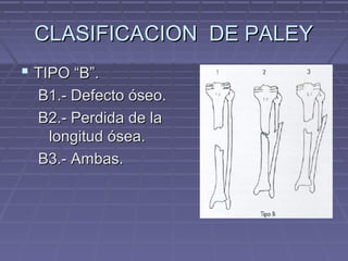 CCLLAASSIIFFIICCAACCIIOONN DDEE PPAALLEEYY 
 TTIIPPOO ““BB””.. 
BB11..-- DDeeffeeccttoo óósseeoo.. 
BB22..-- PPeerrddiiddaa ddee llaa 
lloonnggiittuudd óósseeaa.. 
BB33..-- AAmmbbaass.. 
 